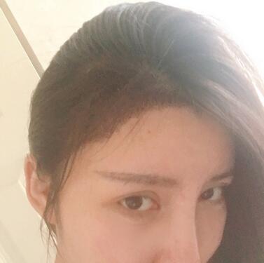 廣州倍生發(fā)際線(xiàn)種植前后對(duì)比照片