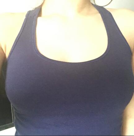 武漢憶美凱德自體脂肪經(jīng)歷分享