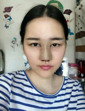 北京八大處范飛隆鼻整形案例