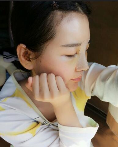 北京八大處范飛隆鼻整形案例