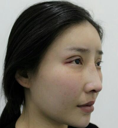 武漢西嬋康美假體隆鼻+眼部綜合整形