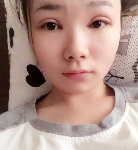 八大處楊明勇做的雙眼皮 半年了