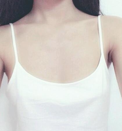 北京八大處穆大力假體隆胸2個月