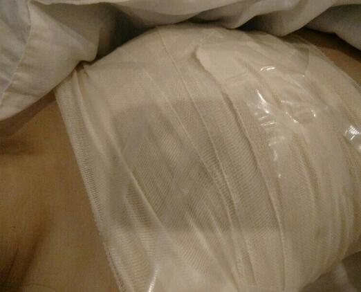 北京八大處穆大力假體隆胸2個月