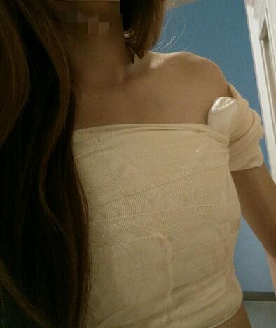 北京八大處穆大力假體隆胸2個月