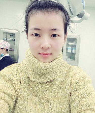 北京八大處辛敏強做雙眼皮怎么樣 案例分享