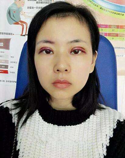 北京八大處辛敏強做雙眼皮怎么樣 案例分享