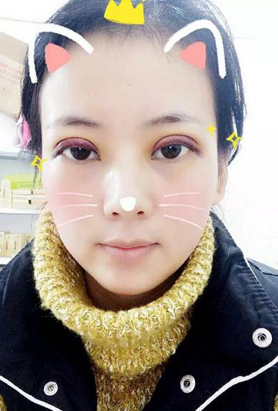 北京八大處辛敏強做雙眼皮怎么樣 案例分享