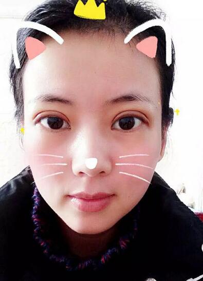 北京八大處辛敏強做雙眼皮怎么樣 案例分享