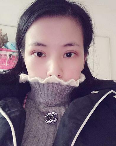 北京八大處辛敏強做雙眼皮怎么樣 案例分享