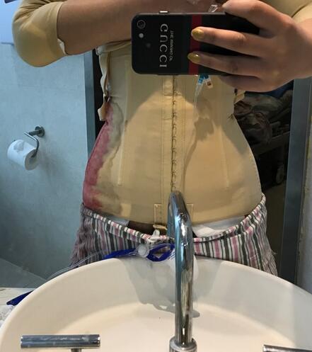 腹部吸脂兩個月親身經(jīng)歷 深圳仁安雅吸脂案例