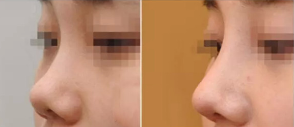 假體隆鼻的果一般可以保持多少年