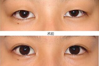 埋線雙眼皮一般能夠保持多少年，是永.久的嗎