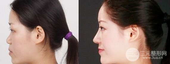 假體隆鼻術(shù)后可以戴眼鏡嗎，有影響嗎