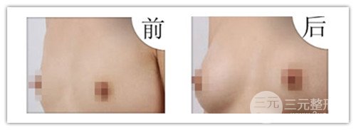 假體隆胸后可以運動嗎，可以鍛煉嗎
