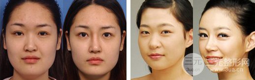 假體隆鼻術(shù)后幾天可以洗臉，如何護理比較好