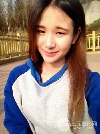 芭比雙眼皮多項(xiàng)整形前后對(duì)比照片 青島諾德曹繼武雙眼皮案例