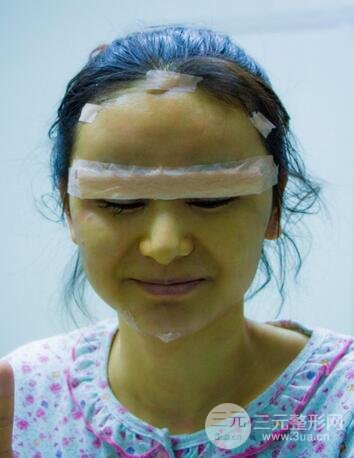 芭比雙眼皮多項(xiàng)整形前后對(duì)比照片 青島諾德曹繼武雙眼皮案例