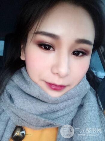 芭比雙眼皮多項(xiàng)整形前后對(duì)比照片 青島諾德曹繼武雙眼皮案例