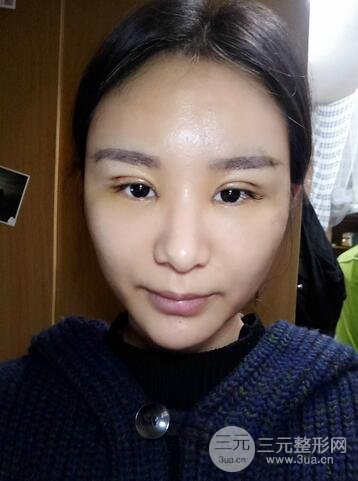 芭比雙眼皮多項(xiàng)整形前后對(duì)比照片 青島諾德曹繼武雙眼皮案例