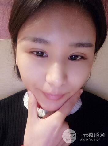 芭比雙眼皮多項(xiàng)整形前后對(duì)比照片 青島諾德曹繼武雙眼皮案例