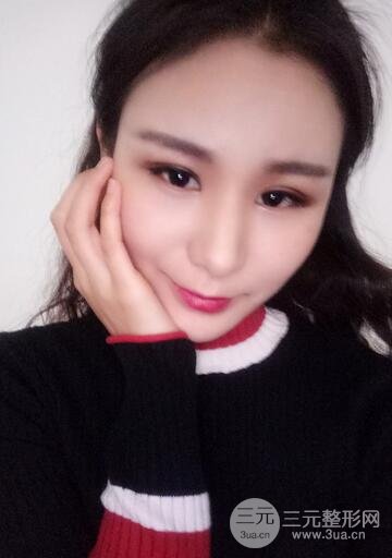 芭比雙眼皮多項(xiàng)整形前后對(duì)比照片 青島諾德曹繼武雙眼皮案例