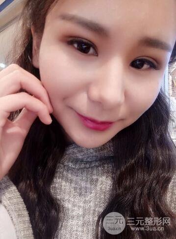 芭比雙眼皮多項(xiàng)整形前后對(duì)比照片 青島諾德曹繼武雙眼皮案例