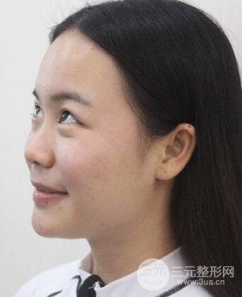 假體隆鼻恢復(fù)過(guò)程實(shí)例 前后果對(duì)比