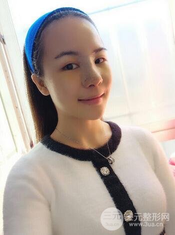 假體隆鼻恢復(fù)過(guò)程實(shí)例 前后果對(duì)比