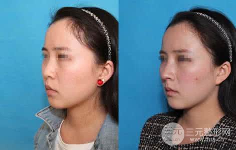 假體隆鼻術(shù)后多久可以取出，取出難度高嗎