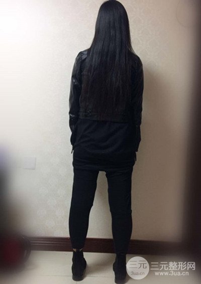 大腿抽脂真實過程圖，輕松擁有細長雙腿