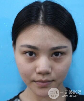 在漢中韓美做了隆鼻整形一個月，恢復越來越自然了