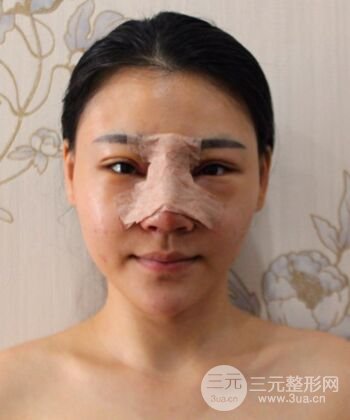 在漢中韓美做了隆鼻整形一個月，恢復越來越自然了