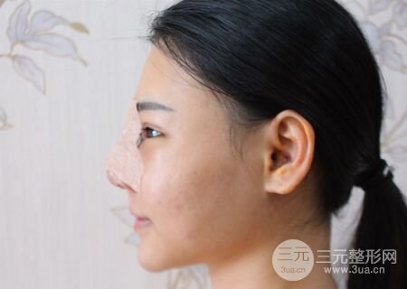 在漢中韓美做了隆鼻整形一個月，恢復越來越自然了