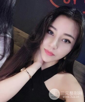 在漢中韓美做了隆鼻整形一個月，恢復越來越自然了