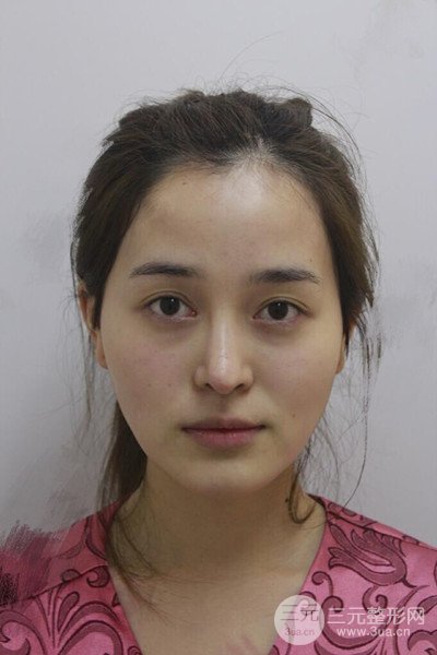 自體脂肪面部填充后成活率超高，少女感十足