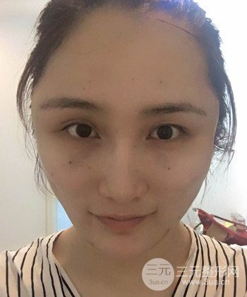面部埋埋蛋白線.提升前后對(duì)比照片,皮膚緊致了不少