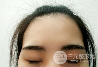 漢中韓美切開雙眼皮開眼角恢復(fù)對(duì)比照片