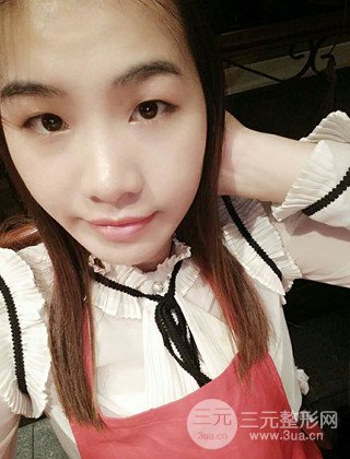 漢中韓美切開雙眼皮開眼角恢復(fù)對(duì)比照片