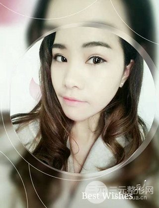 漢中韓美切開雙眼皮開眼角恢復(fù)對(duì)比照片
