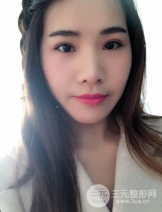 漢中韓美切開雙眼皮開眼角恢復(fù)對(duì)比照片