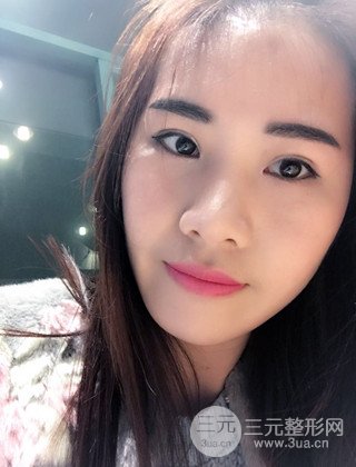 漢中韓美切開雙眼皮開眼角恢復(fù)對(duì)比照片