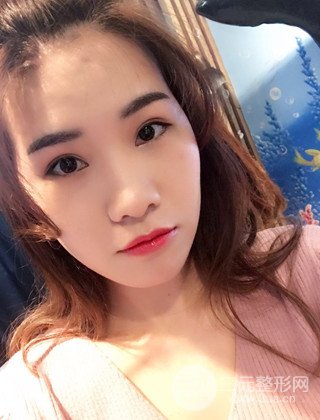漢中韓美切開雙眼皮開眼角恢復(fù)對(duì)比照片