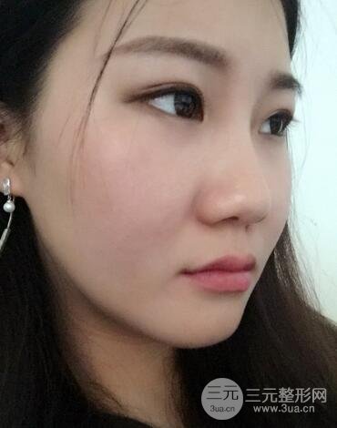 長沙鵬愛隆鼻整形果展示 恢復過程圖