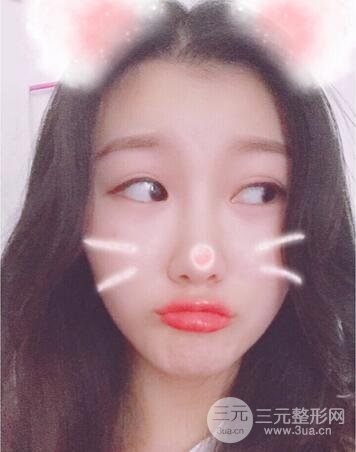 長沙鵬愛隆鼻整形果展示 恢復過程圖