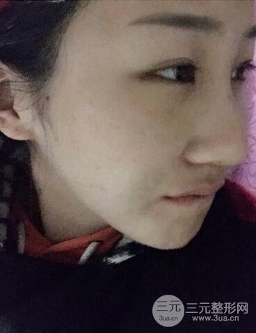 長沙鵬愛隆鼻整形果展示 恢復過程圖