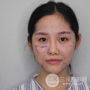 南京米尚恩陳天杰自體脂肪填充全臉 女神的養(yǎng)成記！