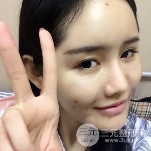 南京米尚恩陳天杰自體脂肪填充全臉 女神的養(yǎng)成記！