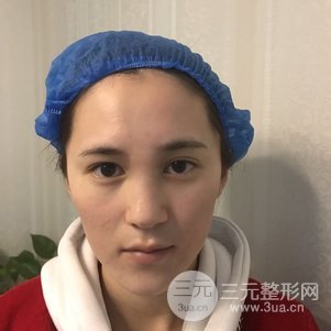 隆鼻整形多少錢 南京克拉美隆鼻整形案例