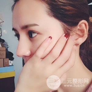 隆鼻整形多少錢 南京克拉美隆鼻整形案例